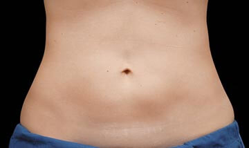 Coolsculpting Female Abdomen After