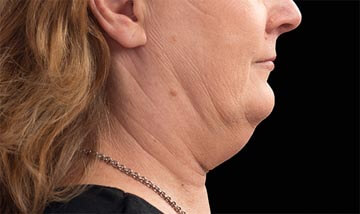 Coolsculpting Female Face Before