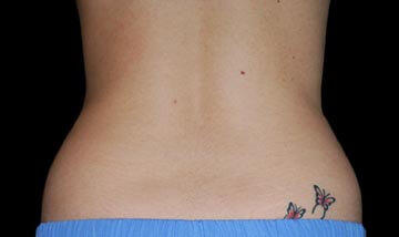 Coolsculpting Female Side After